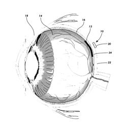 Magnetic retinal patch