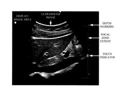 Ultrasound Focal Zone System and Method