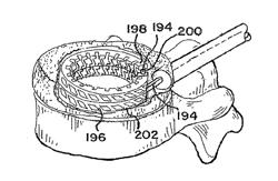 Devices For Treating The Spine