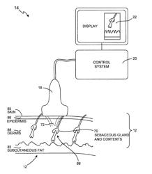 Method and sysem for non-ablative acne treatment and prevention