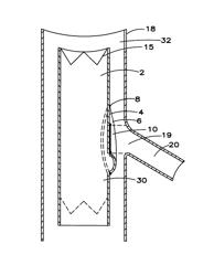 STENT GRAFT WITH FENESTRATION