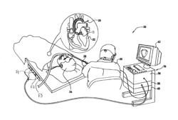 CATHETER WITH COMBINED POSITION AND PRESSURE SENSING STRUCTURES