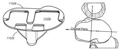 Patient-adapted and improved articular implants, designs and related guide tools