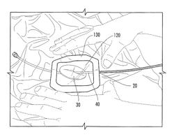 Surgical drapes with patches to provide ports