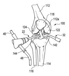 JOINT SURGICAL TREATMENT