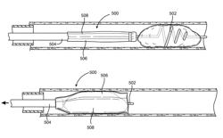 Systems, methods and devices for removing obstructions from a blood vessel