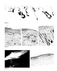 Methods for generating new hair follicles, treating baldness, and hair removal