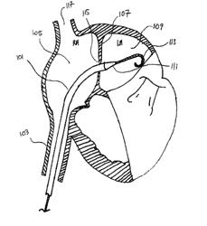 Methods and devices for intra-atrial shunts having selectable flow rates