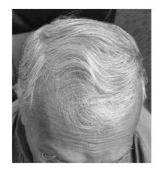 Method of Using a Hair Growth Product