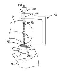 Method for repairing bone defects