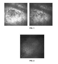 INFLAMMATORY EYE DISORDERS