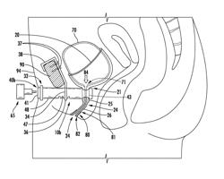 Urinary flow control device and method