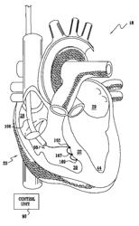 Signal delivery through the right ventricular septum