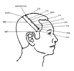 Implantable electroacupuncture system and method for treating parkinson's disease and essential tremor through application of stimului at or near an acupoint on the chorea line