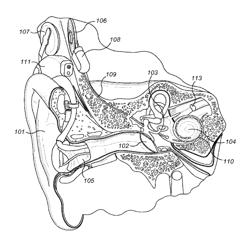 Deep electrode insertion fitting in cochlear implant patients with residual hearing