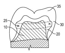 HIGH STRENGTH SUBSTRUCTURE REINFORCEMENT FOR CROWNS AND BRIDGES