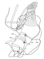 Compression Device