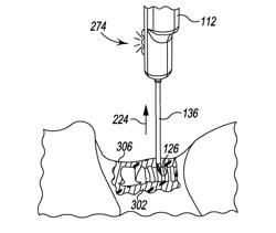 APPARATUS AND METHOD FOR FORMING AN OPENING IN PATIENT'S TISSUE