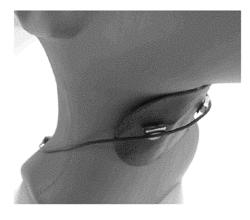 TRANSDERMAL ELECTRICAL STIMULATION AT THE NECK TO INDUCE NEUROMODULATION