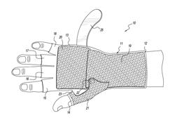 Hand Orthoses