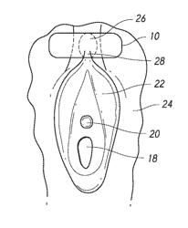 SYSTEMS AND METHODS FOR TREATING FEMALE INCONTINENCE AND PELVIC NERVE DYSFUNCTION