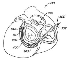 MITRAL VALVE ANNULOPLASTY DEVICE WITH TWISTED ANCHOR