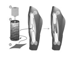 SHAPE-MEMORY-ACTUATED MATERIALS FOR ACCELERATED HEALING OF ORTHOPEDIC INJURIES