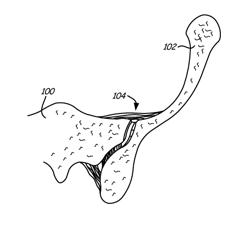 Sacroiliac joint immobilization