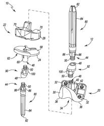 SYSTEM FOR PREPARING A PATIENT'S TIBIA IN AN ORTHOPAEDIC JOINT REPLACEMENT PROCEDURE