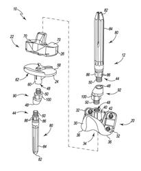 METHOD FOR PREPARING A PATIENT'S TIBIA IN AN ORTHOPAEDIC JOINT REPLACEMENT PROCEDURE