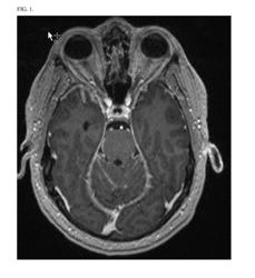 USE OF MARIZOMIB FOR THE TREATMENT OF CENTRAL NERVOUS SYSTEM (CNS) CANCERS