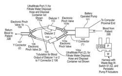 Wearable Ultrafiltration Devices Methods and Systems