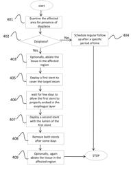 Device and Method for Treatment of Barrett's Esophagus