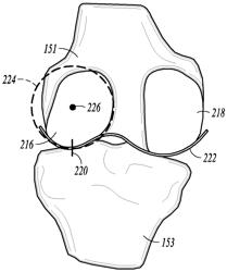 System and method for pre-operatively determining desired alignment of a knee joint