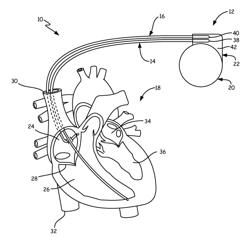 MOULDED IN PLACE SEAL PLUG AND SUTURE ANCHOR