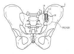 SACROILIAC JOINT IMPLANT SYSTEM