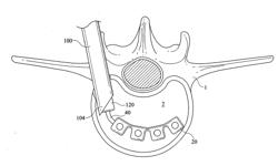 INTERBODY IMPLANTATION SYSTEM AND METHOD