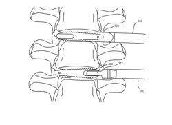 Intervertebral Implant