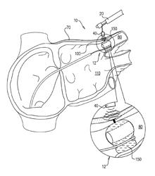 Reflectance-facilitated ultrasound treatment and monitoring