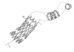 STENT APPARATUS AND TREATMENT METHODS