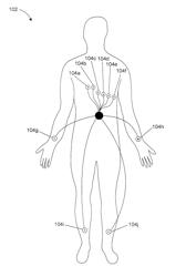 High throughput arrhythmia risk assessment using multilead residua signals