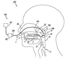 Palate retainer with attached nasopharyngeal airway extender for use in the treatment of obstructive sleep apnea