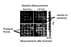 Hyperspectral technology for assessing and treating diabetic foot and tissue disease