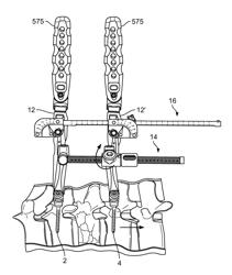 Spinal Trauma Correction and Fixation