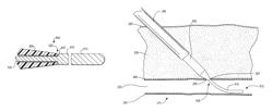 Medical guide element with diameter transition