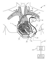 COMMUNICATION METHODS AND ARCHITECTURE FOR HEART TREATMENT SYSTEMS