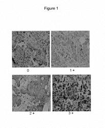 Methods for diagnosis of and predicting treatment efficacy of hormone receptor expressing tumors, cancers and neoplasias