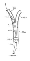 Methods And Systems For Establishing Retrograde Carotid Arterial Blood Flow