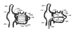 Intracardiac cage and method of delivering same