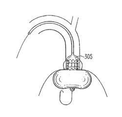 IMPLANTABLE PROSTHETIC VALVE